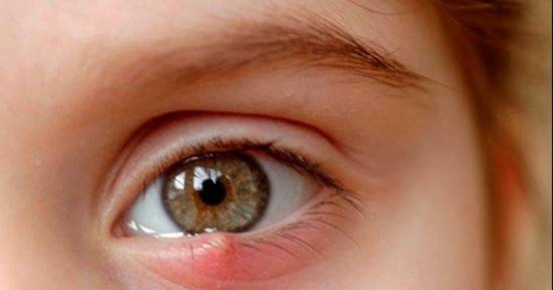 6 طرق منزلية لعلاج دمل و شحاد العين