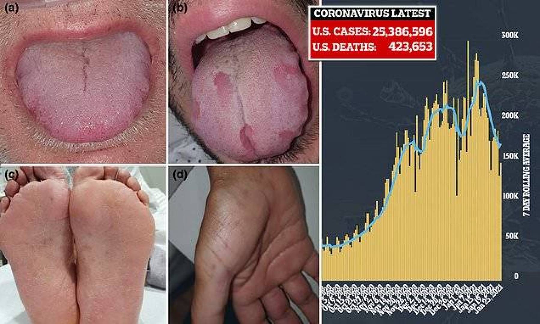 لسان كوفيد وأعراض في اليدين والقدمين تظهر على 1 من بين كل 4 مرضى بفيروس كورونا 