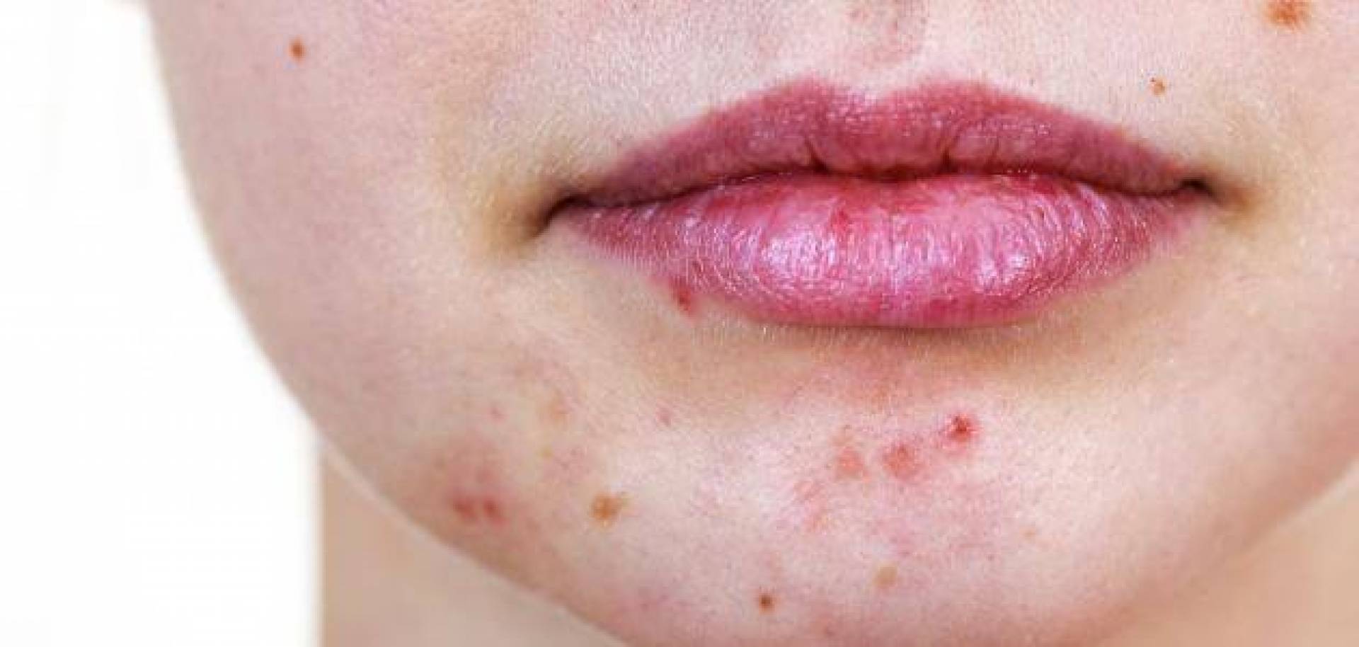 علاجات حب الشباب وندوبها بطرق طبيعية في المنزل