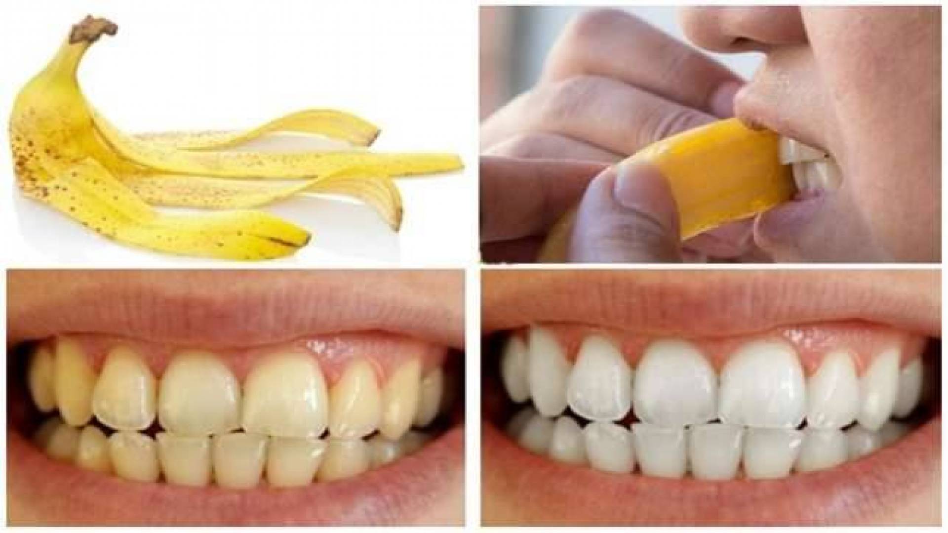 Зубы желтый чистить. Отбеливание зубов банановой кожурой. Банановая кожура отбеливает зубы. Банановая кожура для отбеливания зубов. Отбеливание зубов шкуркой от банана.