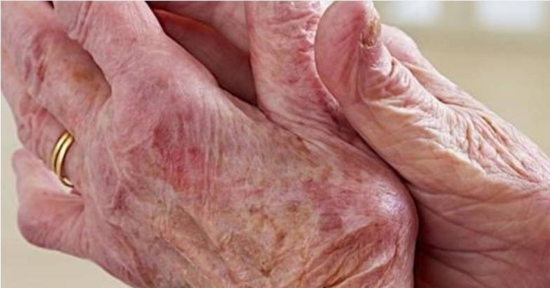 الأدوية المضادة للروماتيزم قد تقلل من الإصابة بمرض الزهايمر لدى الأشخاص المصابين بأمراض القلب 
