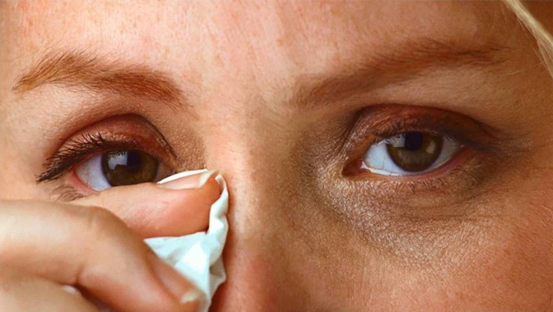Почему из глаз течет слеза причины. Аллергический кератит глаз. Конъюнктивит пингвекула.