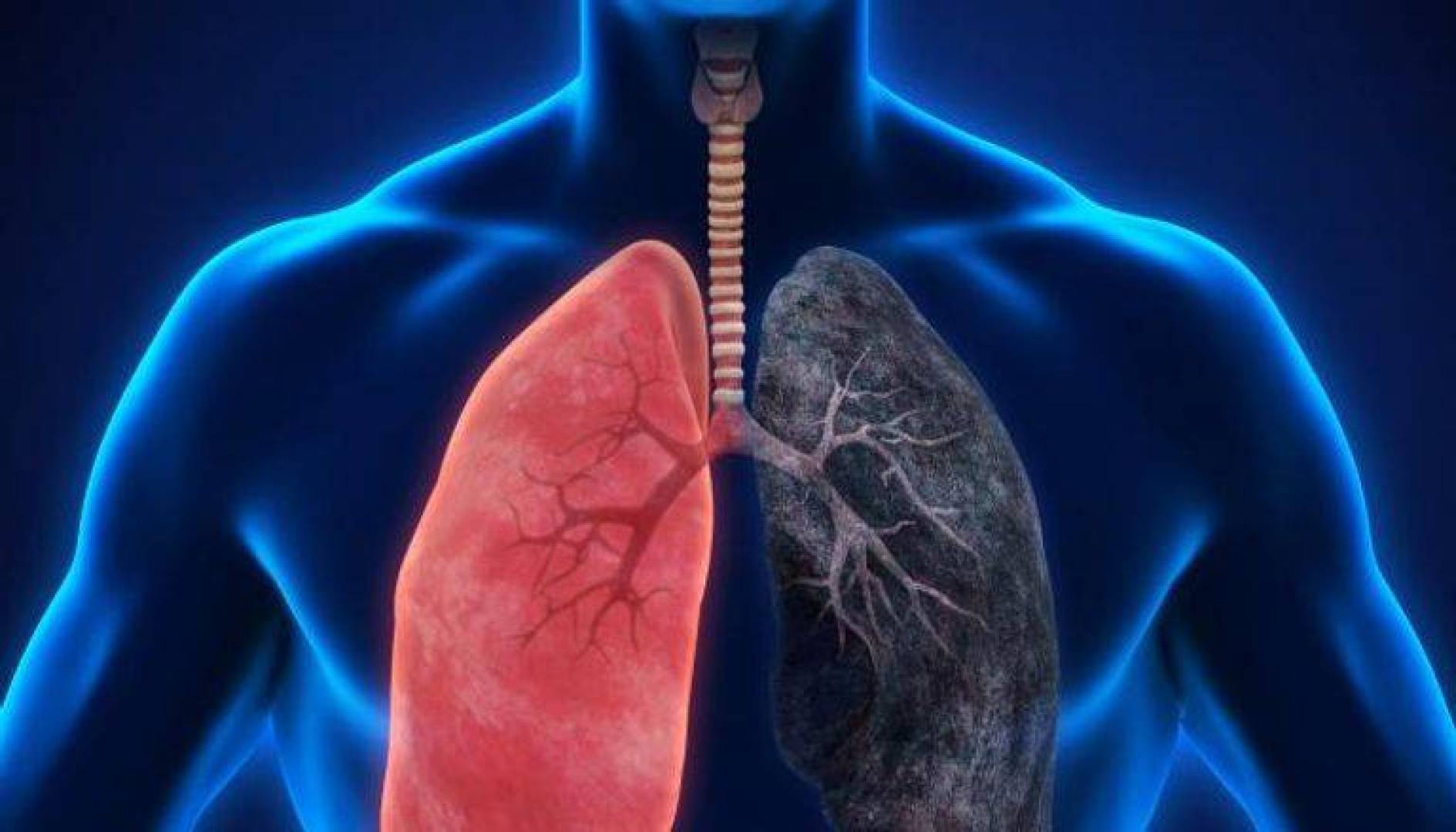 Хроническим заболеванием дыхательных. ХОБЛ хронический бронхит курильщика. Хроническая обструктивная болезнь легких (ХОБЛ).