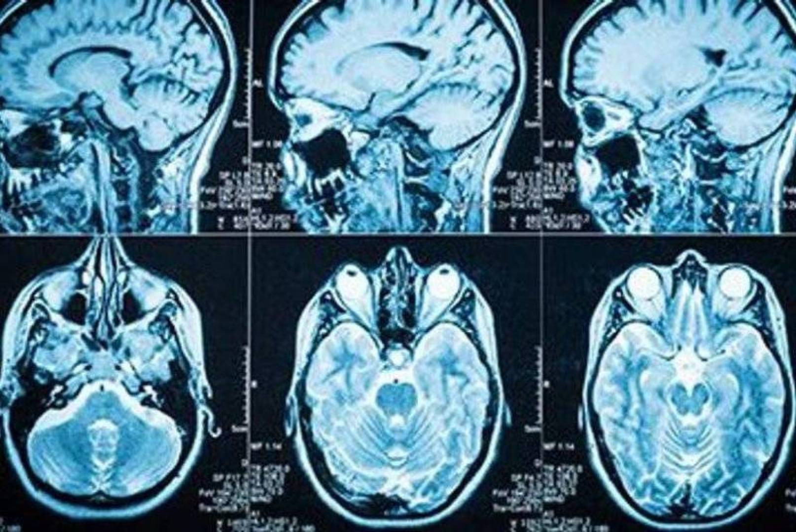 العلاج بهرمون النمو يرتبط بتراكم بروتين أميلويد بيتا الخاص بمرض الزهايمر