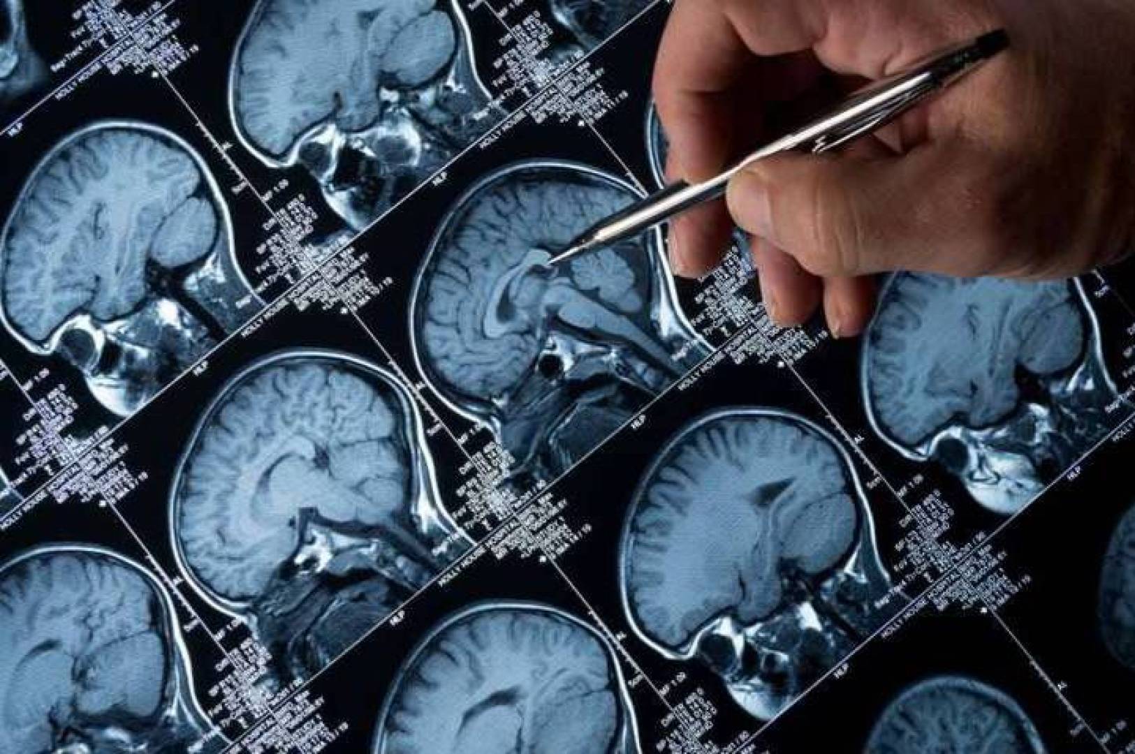 تطوير أداة مدعومة بالذكاء الاصطناعي لتحسين دقة تشخيص الزهايمر