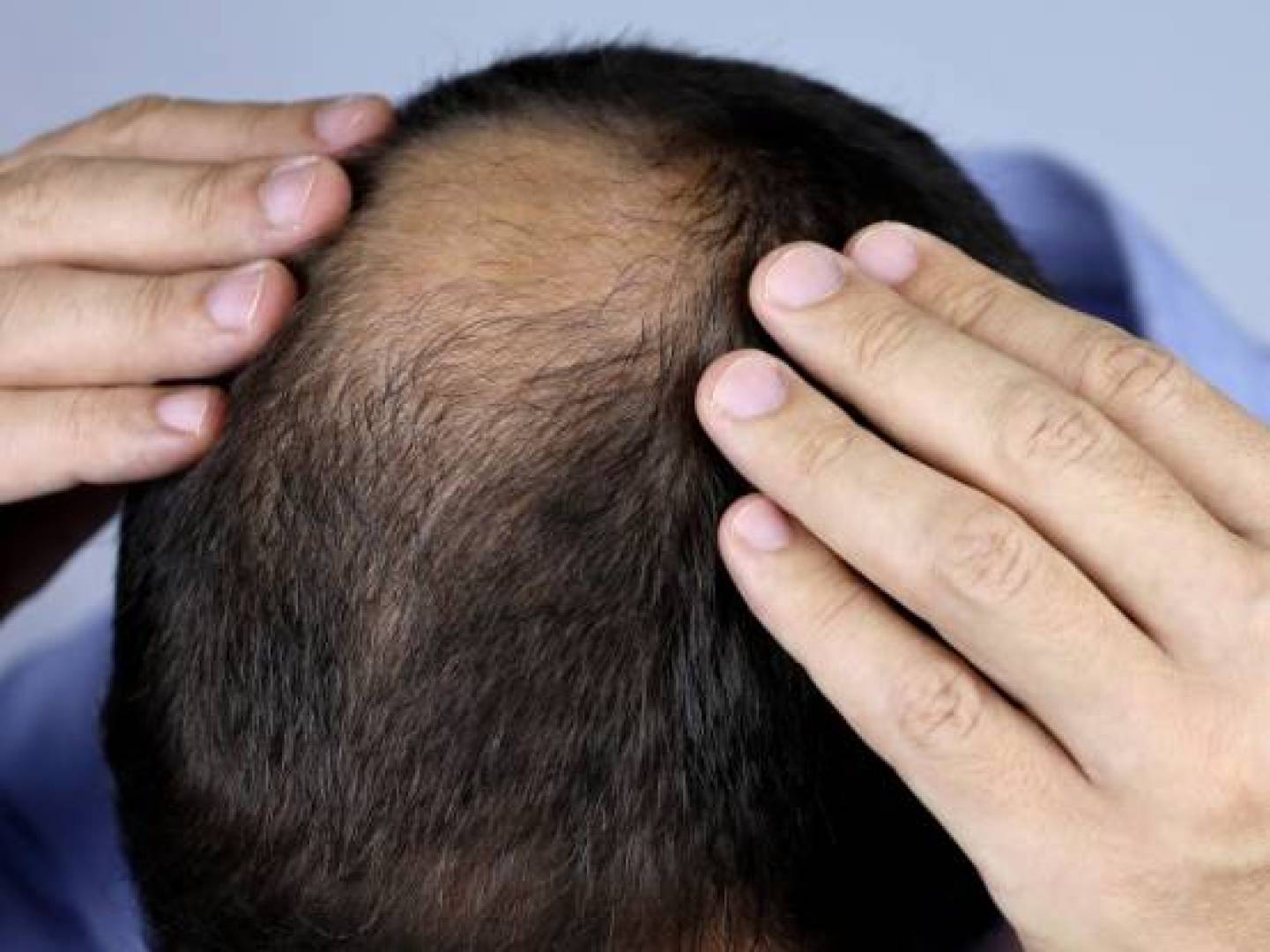علاج طبيعي جديد يُعيد نمو الشعر بكثافة مذهلة