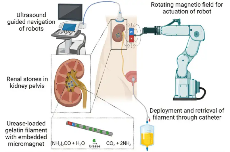 روبوتات طبية دقيقة لتفتيت حصوات الكلى 