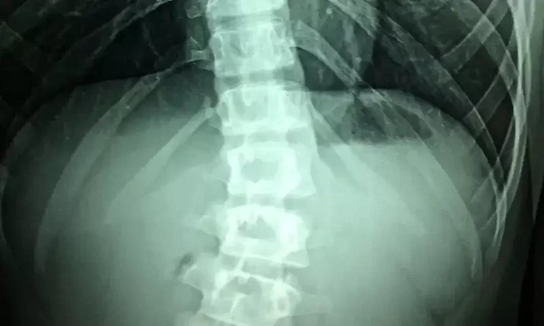 محفزات الحبل الشوكي: علاج شائع ولكنه مكلف ومحفوف بالمخاطر