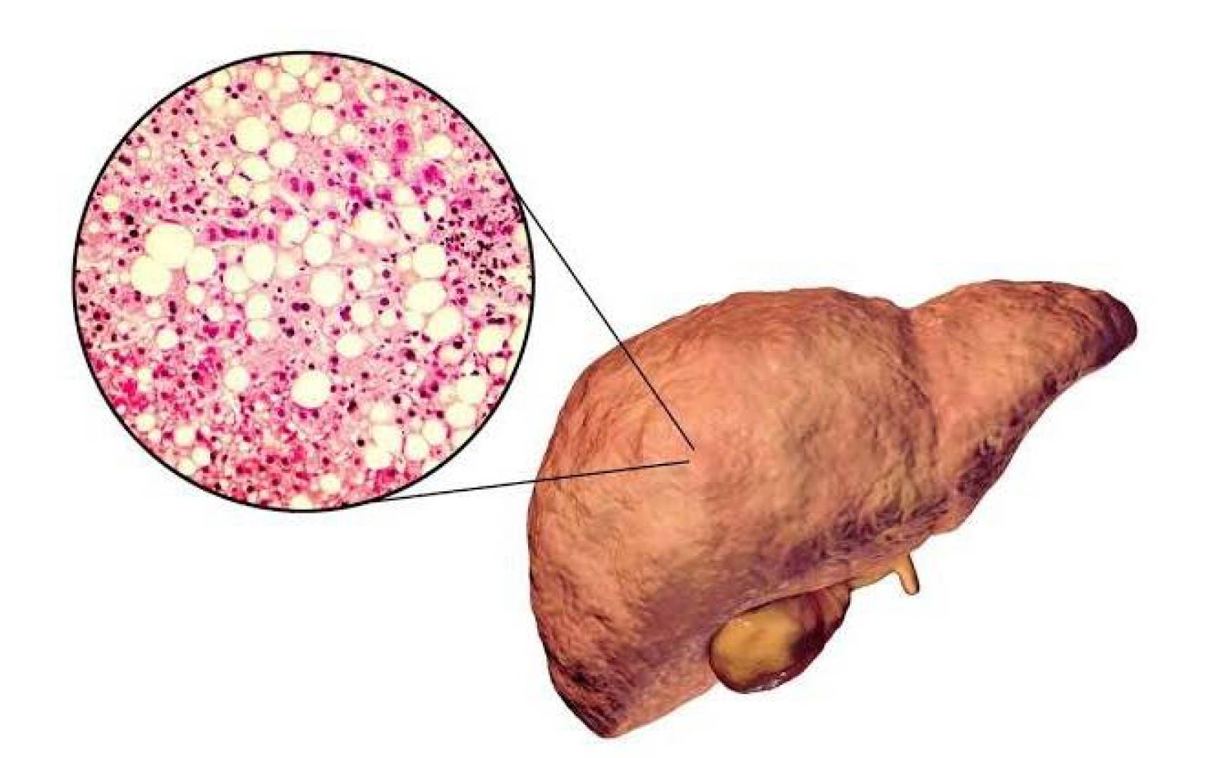 Metabolic Fatty Liver: New Protein Discovery Offers Hope