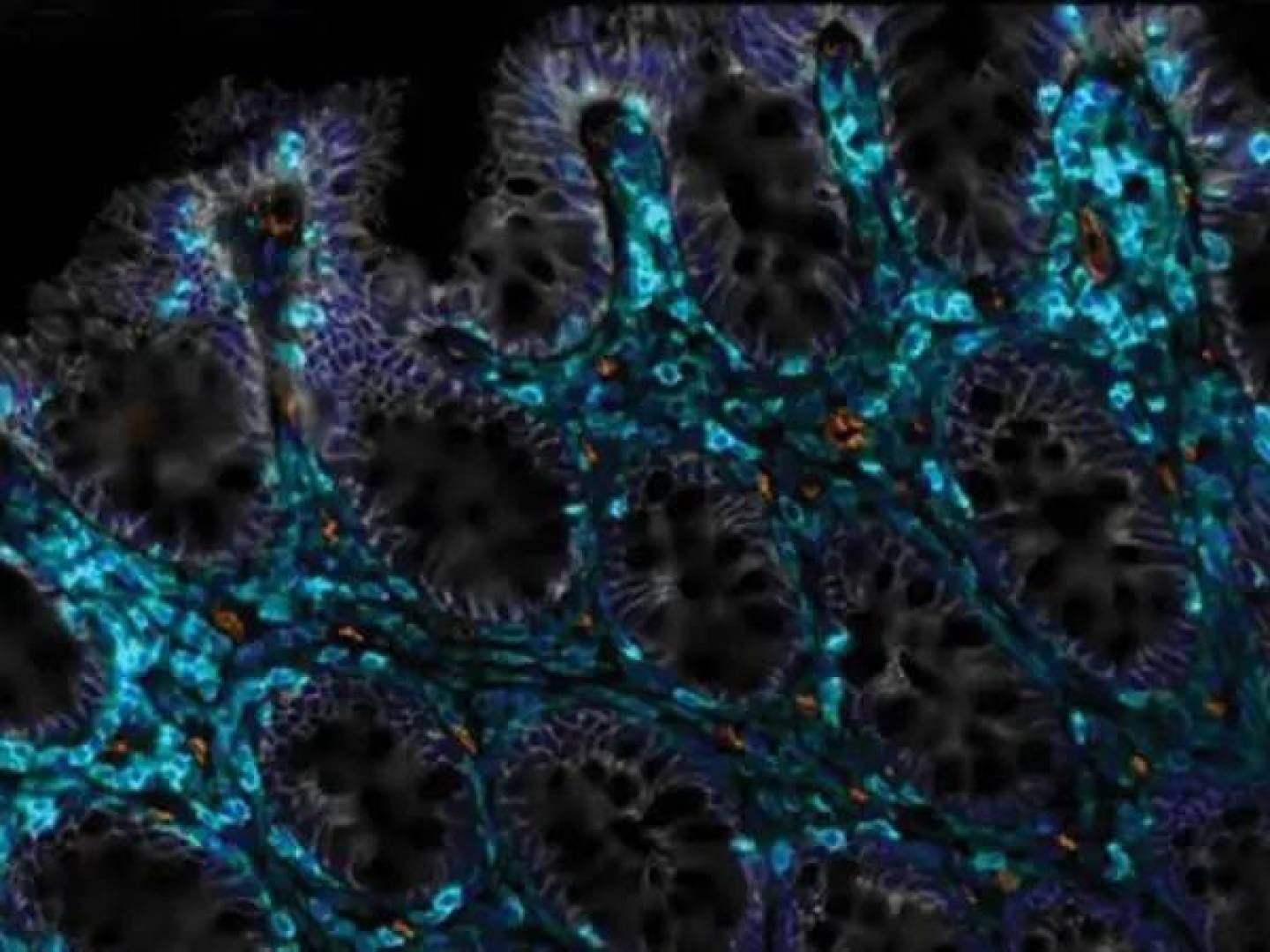 Sebum Metabolism & Skin Inflammation in Psoriasis: New Link Discovered