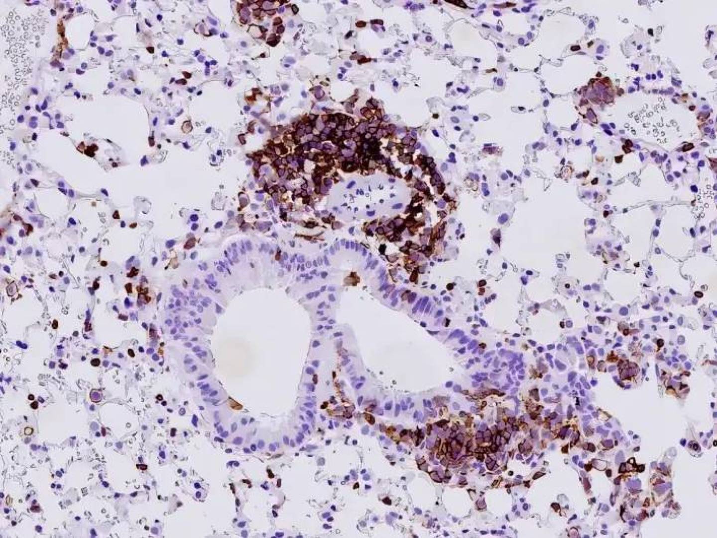آلية جديدة تفسّر عدوانية سرطان الرئة صغير الخلايا | النهضة نيوز