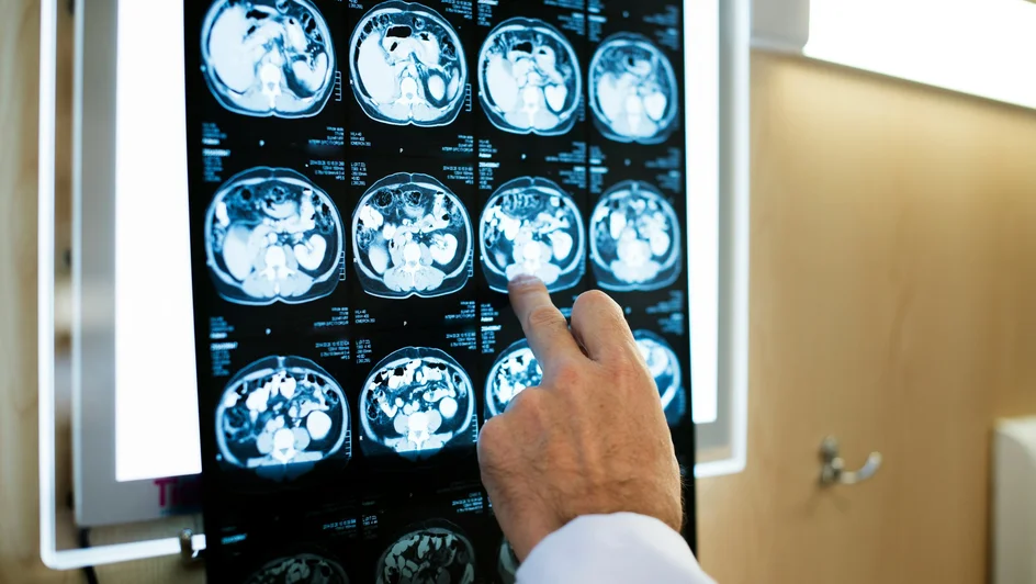 التنبؤ بنوبات الصرع ( مصدر الصورة: جامعة غلاسكو كاليدونيان )