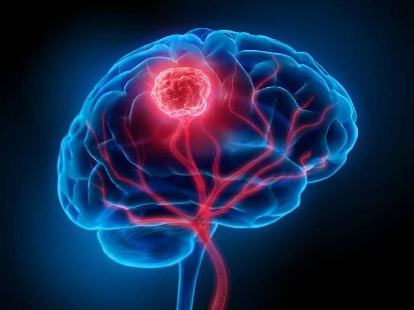 قطرات أنف بسيطة تعالج أخطر أنواع سرطان الدماغ | النهضة نيوز