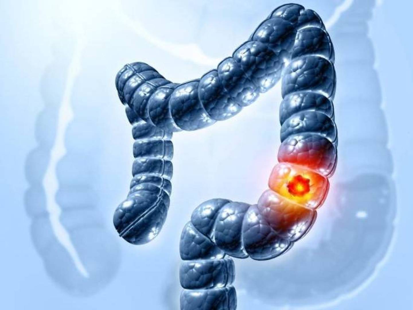 كيف يرفع تصلب القولون من خطر الإصابة بسرطان القولون؟ | النهضة نيوز