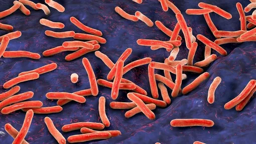 مرض السل المقاوم للأدوية ( مصدر الصورة: جامعة جونز هوبكنز )