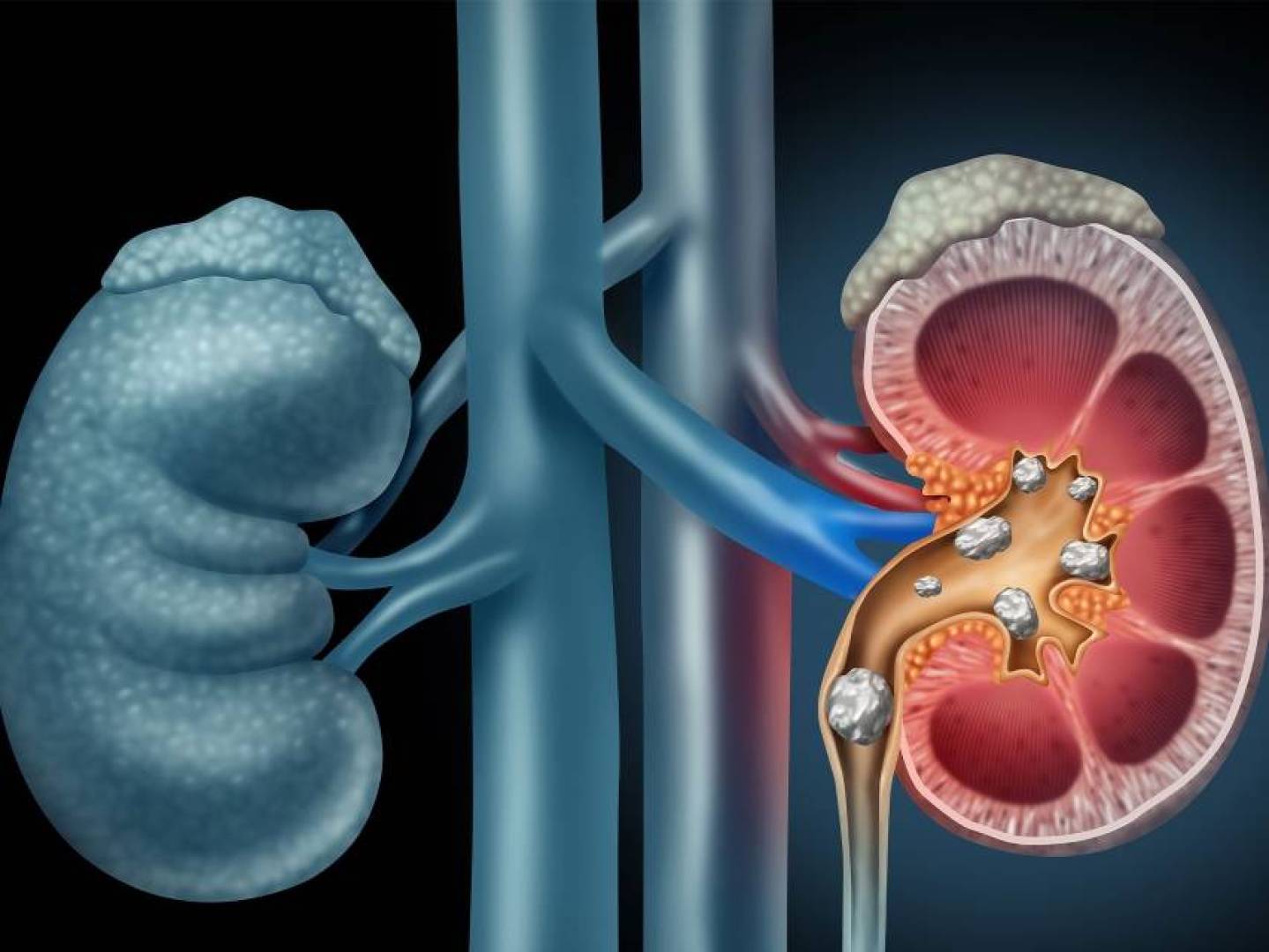شرب الماء لعلاج حصوات الكلى