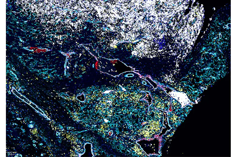 الورم الأرومي العصبي ( مصدر الصورة: Pixabay )