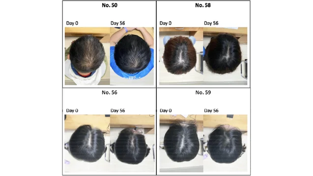 علاج تساقط الشعر ( مصدر الصورة: Freepik )