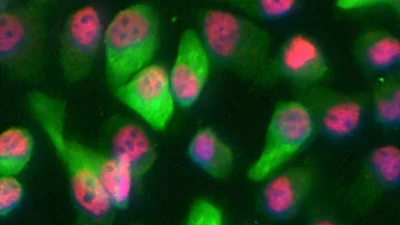 درع بيولوجي يحد من تطور سرطان الجلد العدواني ( مصدر الصورة: الجامعة العبرية في القدس )