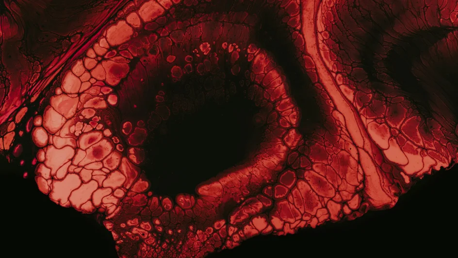 تحول الآفات المبكرة في البنكرياس ( مصدر الصورة: University of Michigan )