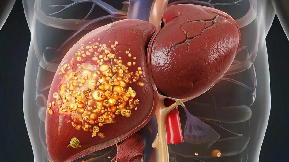 الكبد الدهني غير الكحولي ( مصدر الصورة: جامعة كاليفورنيا )