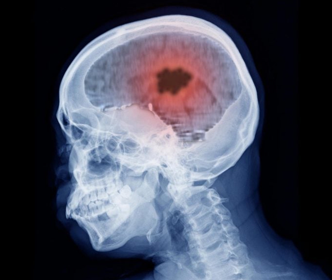 فيتامين B12 لعلاج سرطان الدماغ ( مصدر الصورة: Impact Journals LLC )