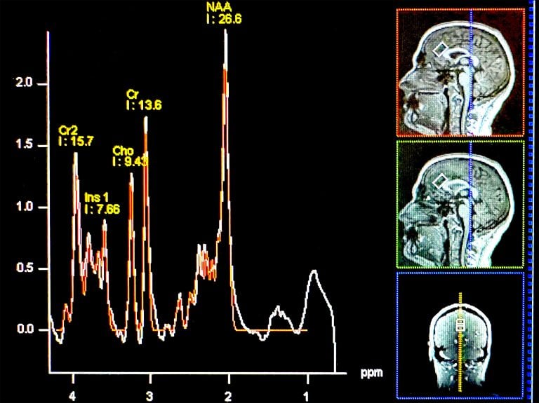 اضطرابات القلق ( مصدر الصورة: جامعة كاليفورنيا )