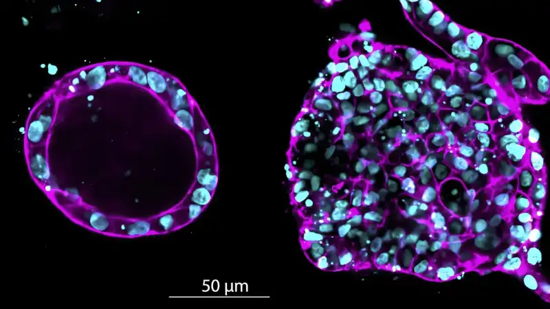 صلابة الورم عامل خفي في انتشار السرطان ( مصدر الصورة: جامعة لوند )