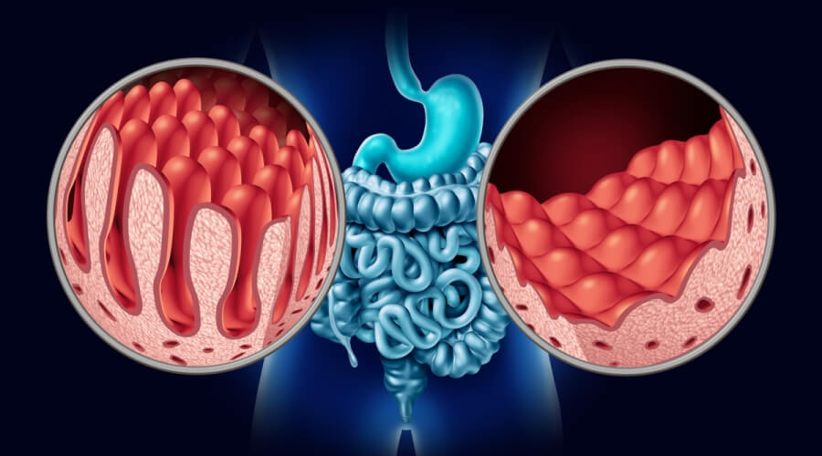 مرض السيلياك ( مصدر الصورة: Pixabay )