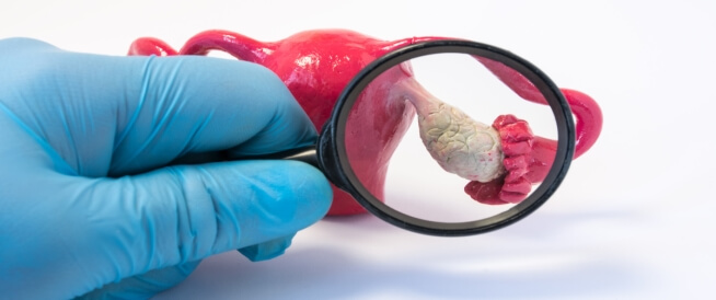 متلازمة تكيس المبايض ( مصدر الصورة: Monash University )