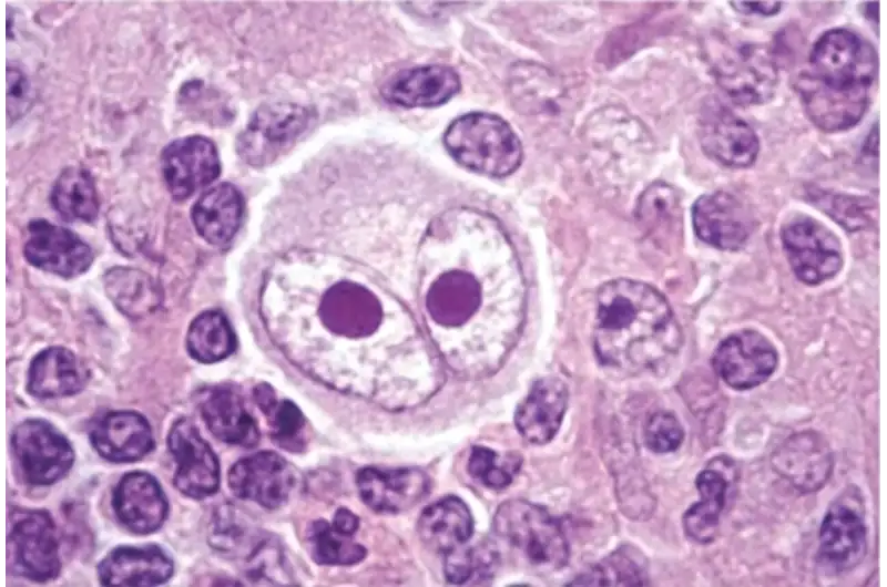خلايا لمفوما هودجكين ( مصدر الصورة: National Cancer Institute )