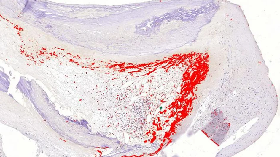علاج الكوليسترول الضار ( مصدر الصورة: جامعة كوليدج لندن )