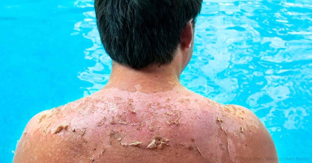 تعرف على كيفية علاج حروق الشمس